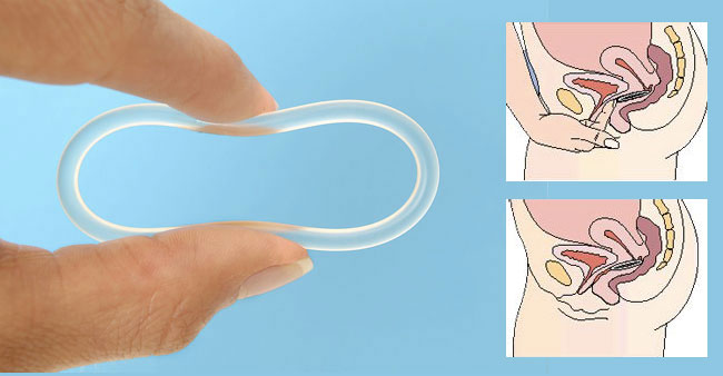 anneau-contraceptif-vaginal